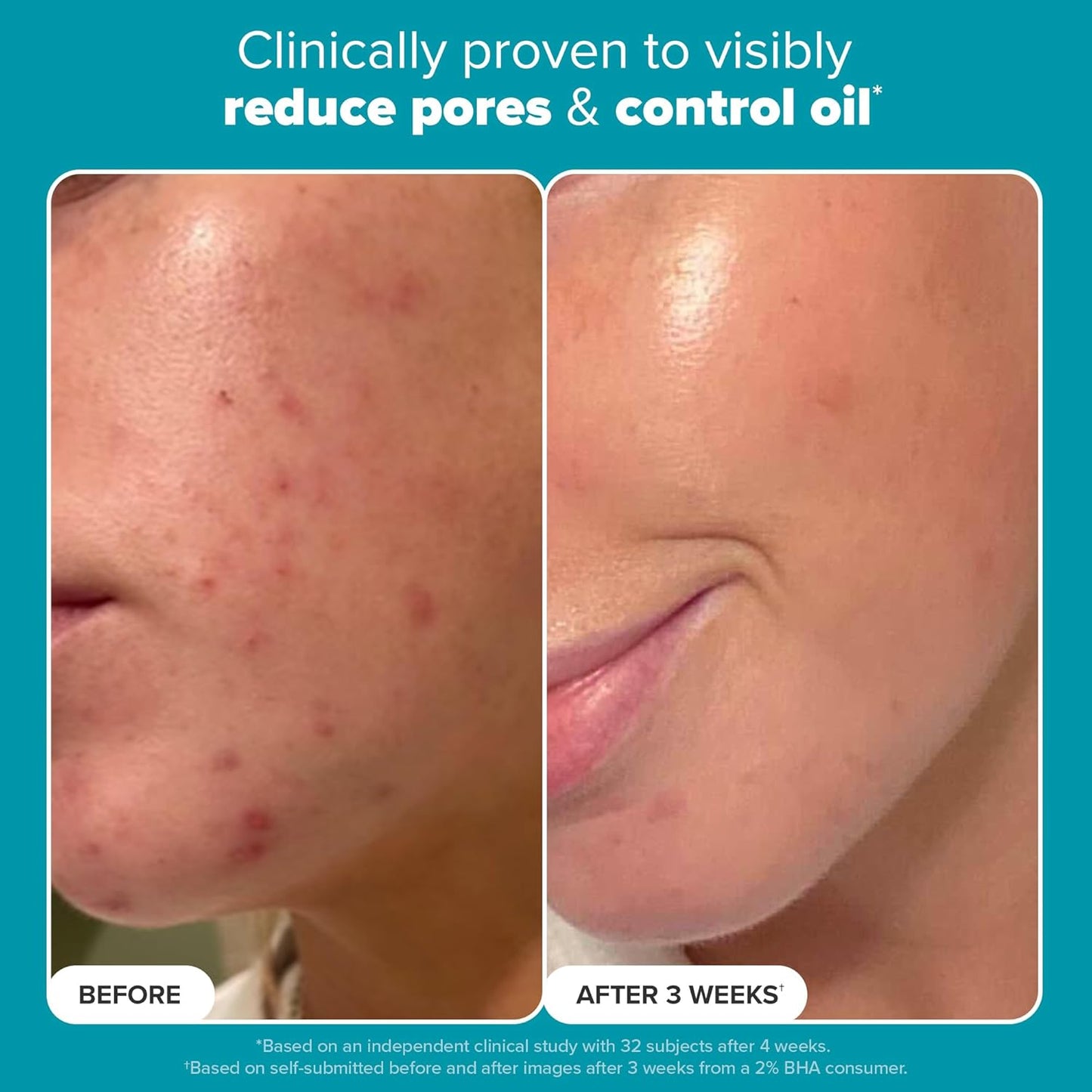 Paula's Choice SKIN PERFECTING 2% BHA Liquid Exfoliant – Salicylic Acid Facial Exfoliator for Pores, Wrinkles & Blackheads – Fragrance-Free